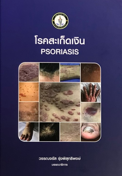 โรคสะเก็ดเงิน (PSORIASIS)