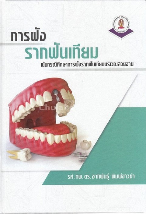 การฝังรากฟันเทียม :เน้นกรณีศึกษาการฝังรากฟันเทียมบริเวณสวยงาม