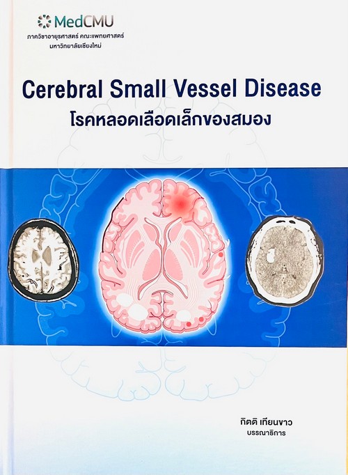 โรคหลอดเลือดเล็กของสมอง (CEREBRAL SMALL VESSEL DISEASE)