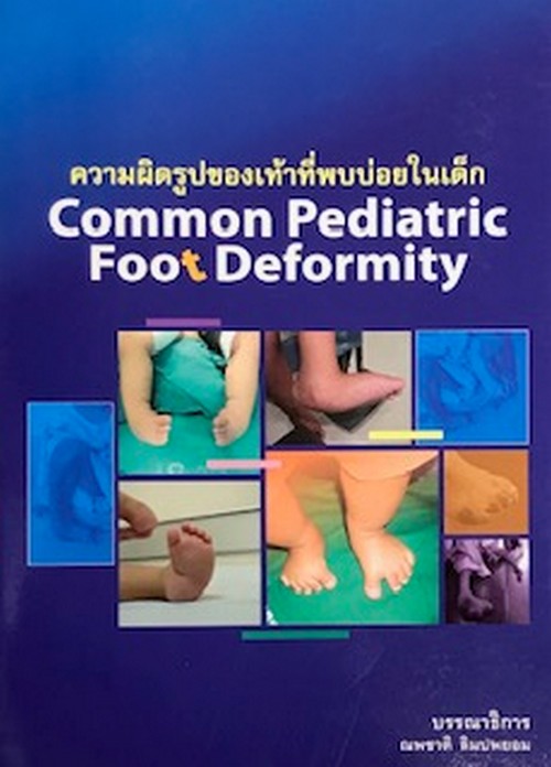 ความผิดรูปของเท้าที่พบบ่อยในเด็ก (COMMON PEDIATRIC FOOT DEFORMITY)