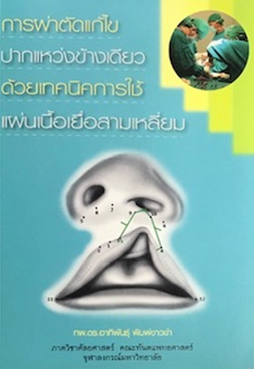 การผ่าตัดแก้ไขปากแหว่งข้างเดียวด้วยเทคนิคการใช้แผ่นเนื้อเยื่อสามเหลี่ยม