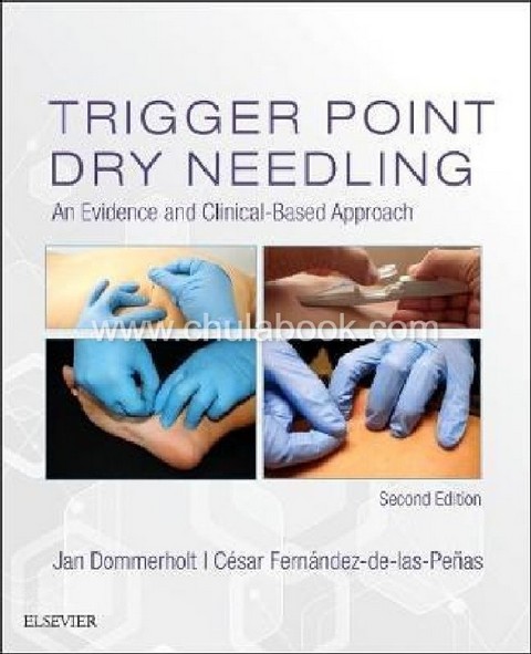 TRIGGER POINT DRY NEEDLING : AN EVIDENCE AND CLINICAL-BASED APPROACH