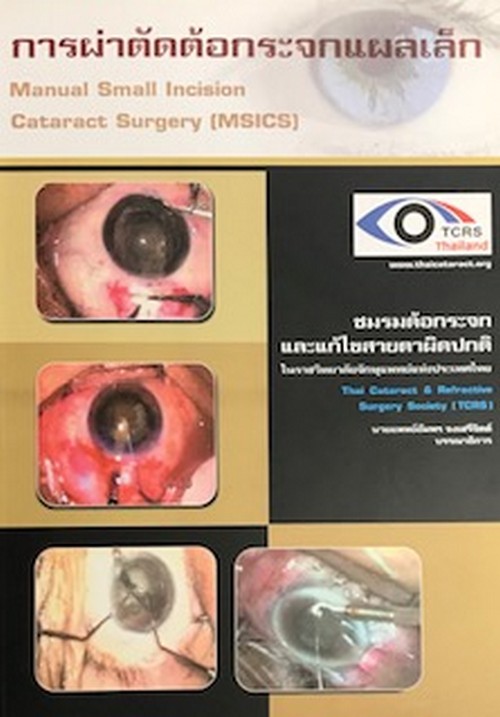 การผ่าตัดต้อกระจกแผลเล็ก (MANUAL SMALL INCISION CATARACT SURGERY (MSICS)) (1 BK./1 CD-ROM)