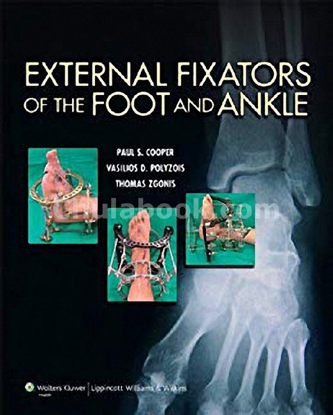 EXTERNAL FIXATORS OF THE FOOT AND ANKLE (HC)